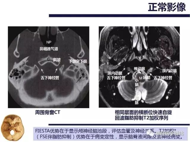 舌下神经和舌咽神经的解剖图,颊神经舌神经解剖图