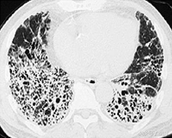 癌症吃靶向药有哪些副作用,吃癌症靶向药有什么副作用吗