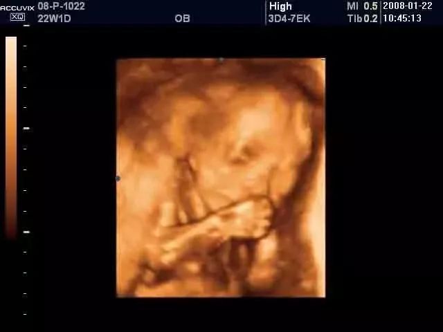 孩子吃手严重怎么戒掉,孩子吃手戒除方法