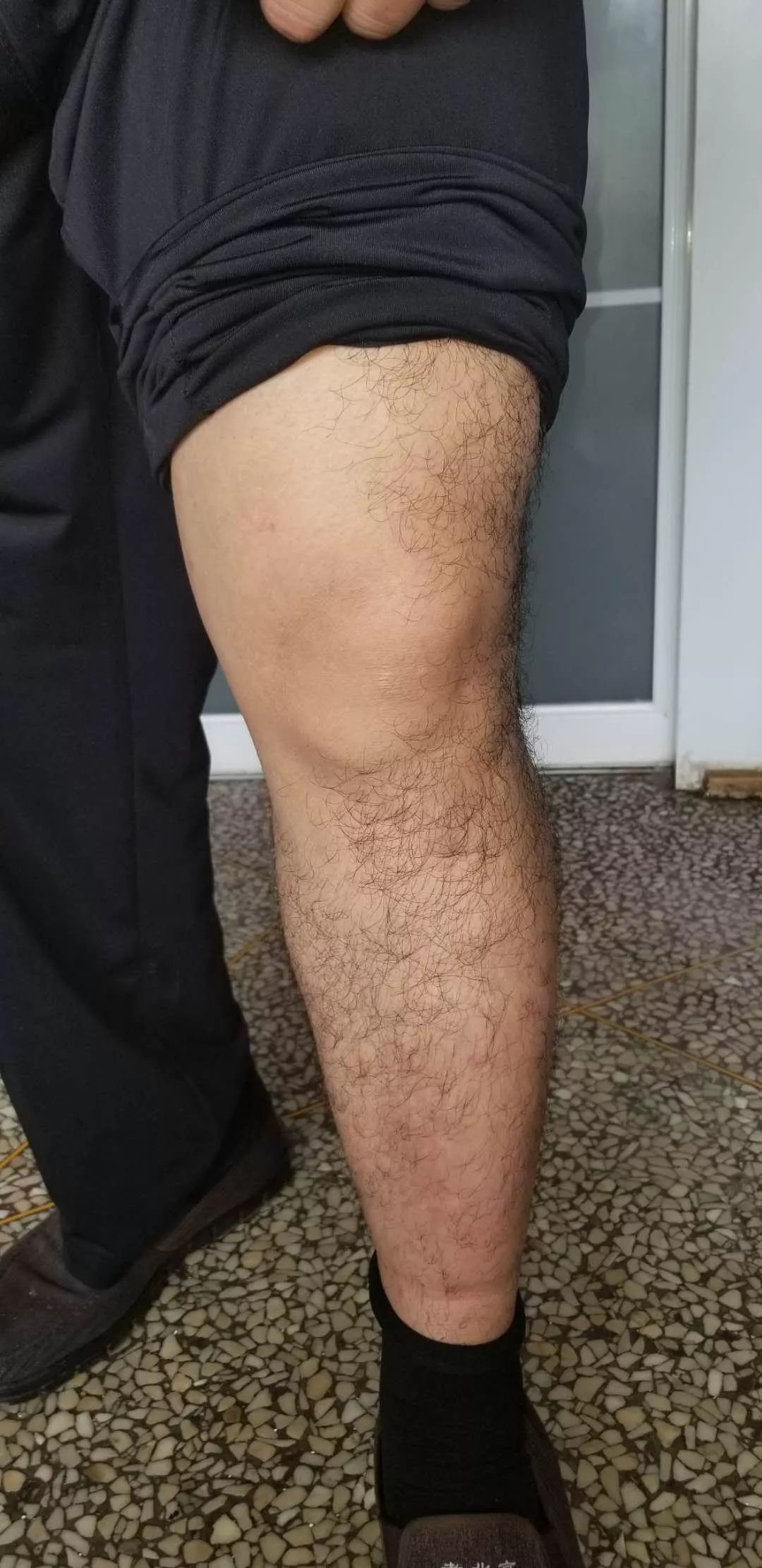 娴欐睙鐪佷腑鍖绘不鐤楅摱灞戠梾,鍏勫紵淇╅兘寰楃櫧鐧滈