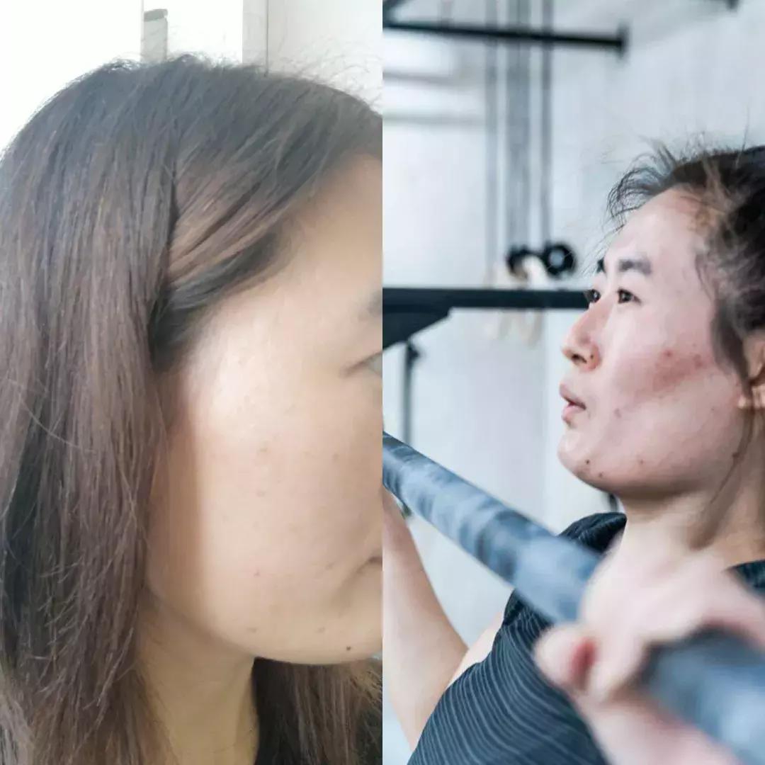 战痘技巧｜林允儿和小甜甜的痘痘可不是一回事