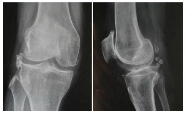 常见的十大膝关节疼痛,老年患者膝关节疾病健康科普