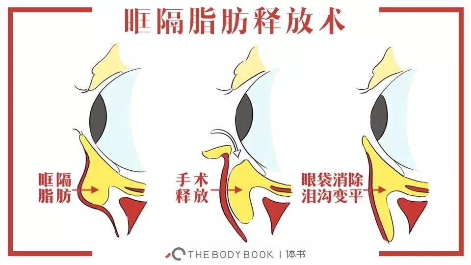 黑眼圈怎么去除最快方法,黑眼圈怎么去除最有效的方法