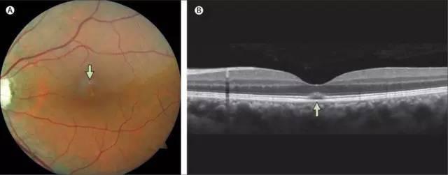 在GAY圈中比“0号胶囊”还流行的Rush是不是*品毒**？有什么危害？
