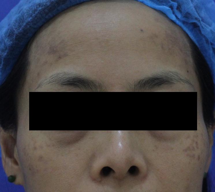 斑不祛掉会越来越多吗,真正有斑敢祛掉吗