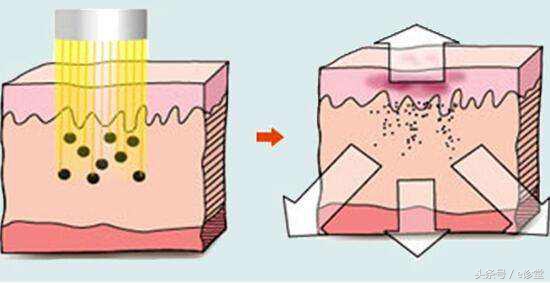 雀斑小常识：如何告别脸上的“小点点”？
