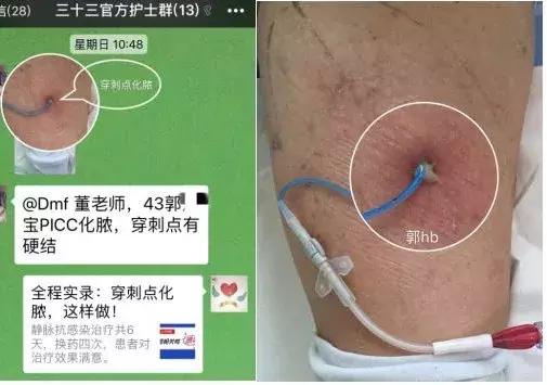 分泌物细菌培养异常,脓性分泌物培养操作