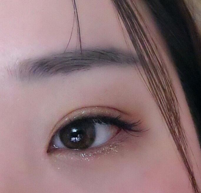 微创双眼皮开眼角3680元贵吗,纳米无痕双眼皮开眼角操作全过程