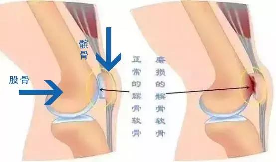 打篮球膝关节酸痛怎么办,打篮球打到胳膊疼是怎么回事
