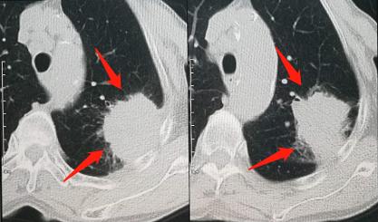 吸烟的肺癌患者放疗效果好吗,70岁肺癌放疗