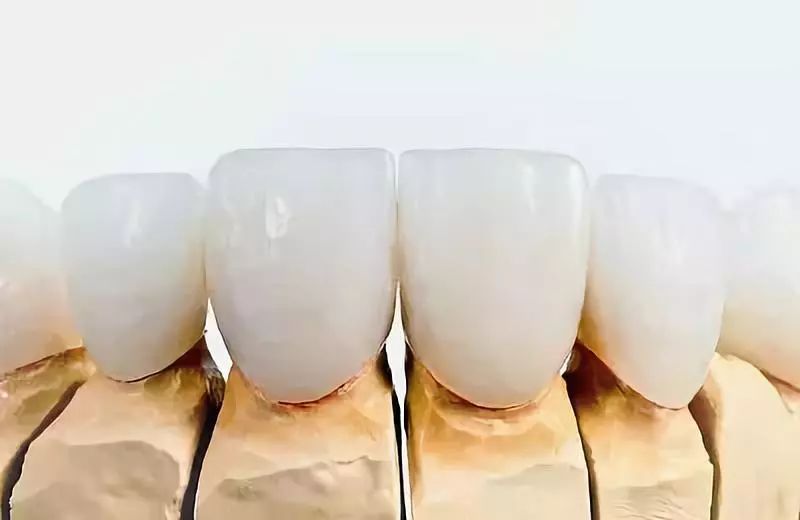 烤瓷牙与全瓷牙价格相差近十倍?究竟贵在哪?