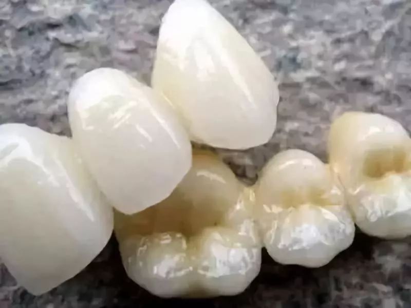 烤瓷牙与全瓷牙价格相差多少,烤瓷牙和全瓷牙价格差多少钱