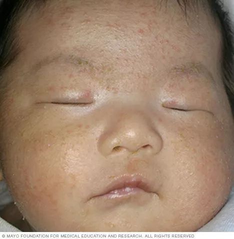 新生儿身上长红色小疹子带白尖,新生儿长疹子怎么办最有效