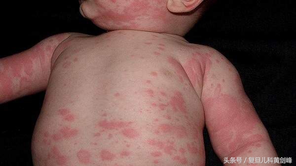 宝宝风疹块怎么引起的,宝宝身上起风疹块原因