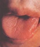 7种舌头暗示健康问题,各种病症舌头的颜色