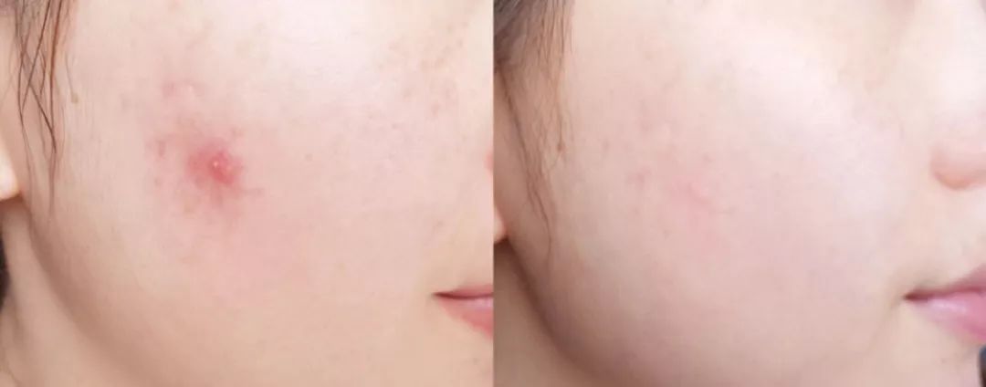 有了这瓶“液体黄金“,今年秋冬注定与干燥、长痘无缘了!