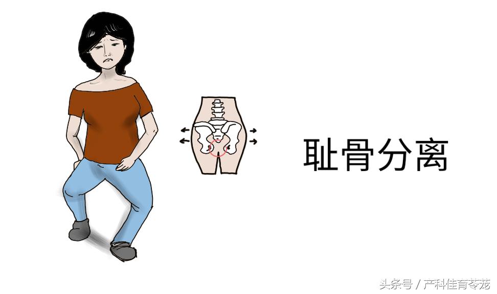 辟谣头胎是剖腹产二胎也必须剖吗,辟谣孕妇分娩