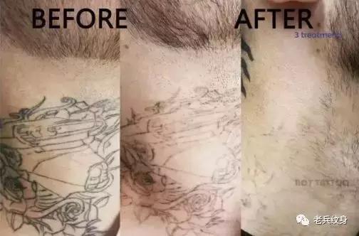 科普洗纹身的那些事儿,洗纹身误区以及洗纹身真实案例