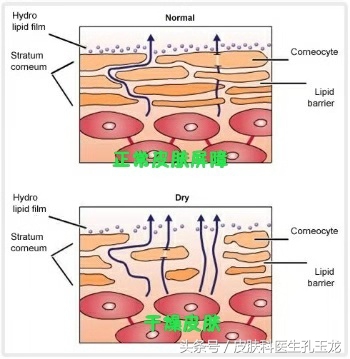 婴儿湿疹导致皮肤干燥怎么治疗,宝宝湿疹皮炎是什么原因引起的