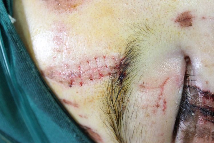 面部外伤后初期疤痕凸起怎么修复,面部外伤凹陷疤痕怎么去除