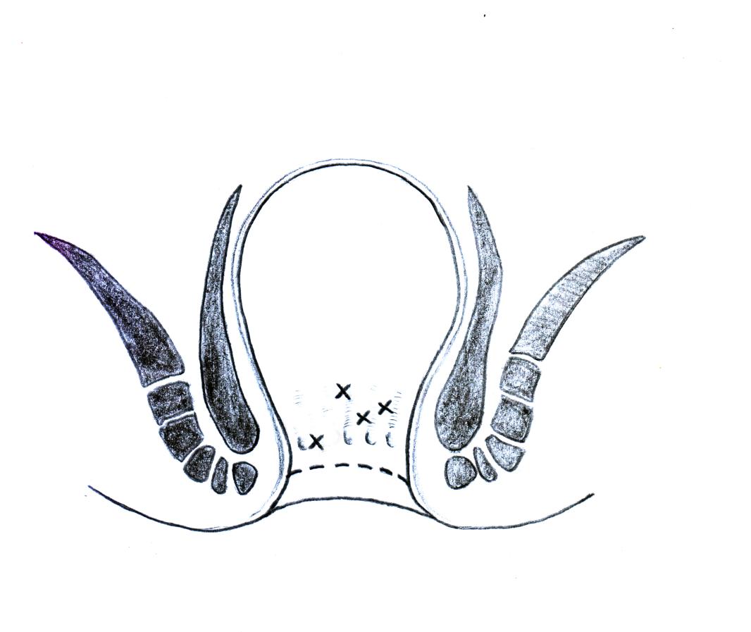 肛肠病诊疗新技术图解,中医肛肠教学