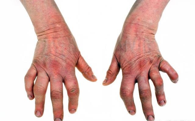 老人手关节疼痛警惕四种病,老人手脚关节痛浮肿是什么原因