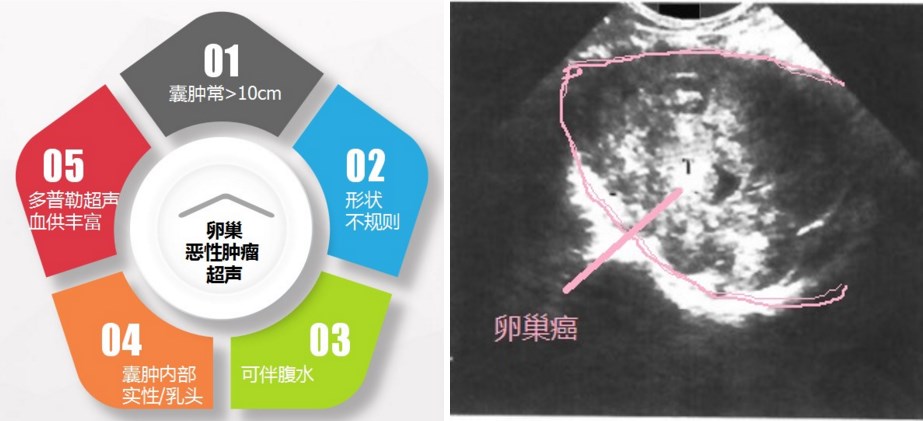 怎么判断卵巢囊肿是恶性还是良性,怎样判断卵巢囊肿是良性还是恶性