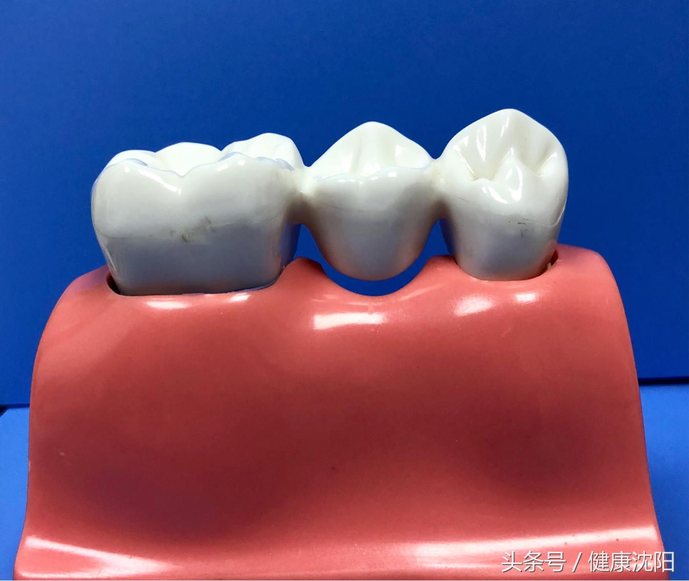 拔牙后一般多久能镶牙,拔牙过后一般多久才能镶牙