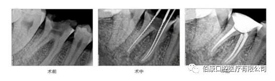 根管治疗的步骤图,根管治疗的步骤和重点