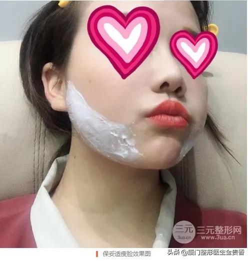 保妥适是玻尿酸还是肉毒素,保妥适效果不明显