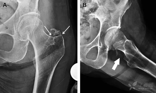放射科夜班病例大全,放射科容易漏诊的骨折