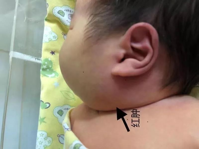 满月宝宝脸一边大一边小怎么办,宝宝一边脸大是什么原因