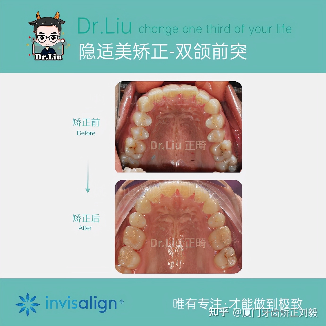 下嘴唇厚且外翻牙齿矫正,深覆合牙齿矫正嘴凸