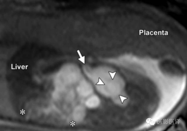 孕期发现卵巢囊肿有8cm左右,孕19周查出胎儿卵巢囊肿