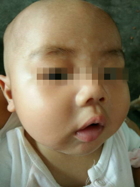 皮肤的小白点怎么解决,皮肤上小白点很痒图片