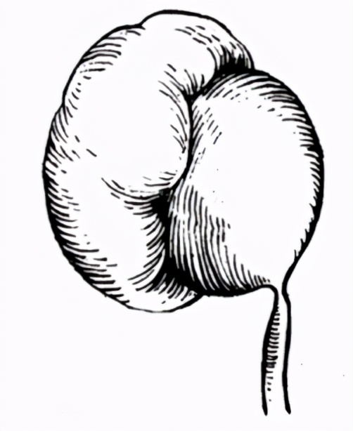 严重肾积水可以保守治疗吗,严重肾积水需要治疗吗