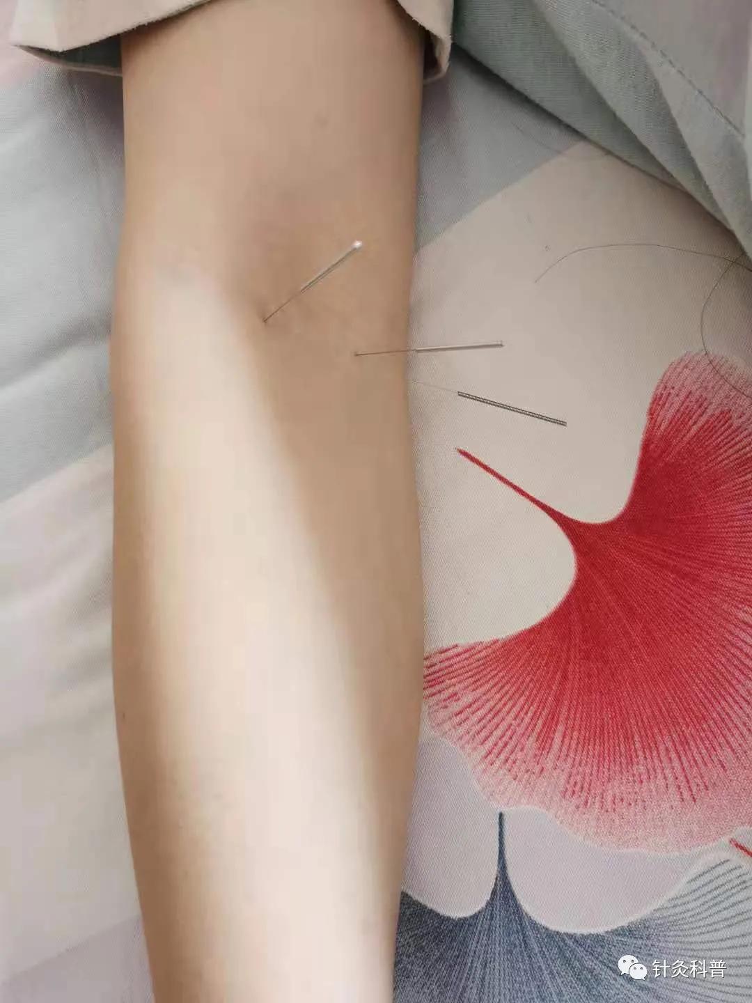 针灸后偏头痛是怎么回事,针灸治疗偏头痛是什么原理