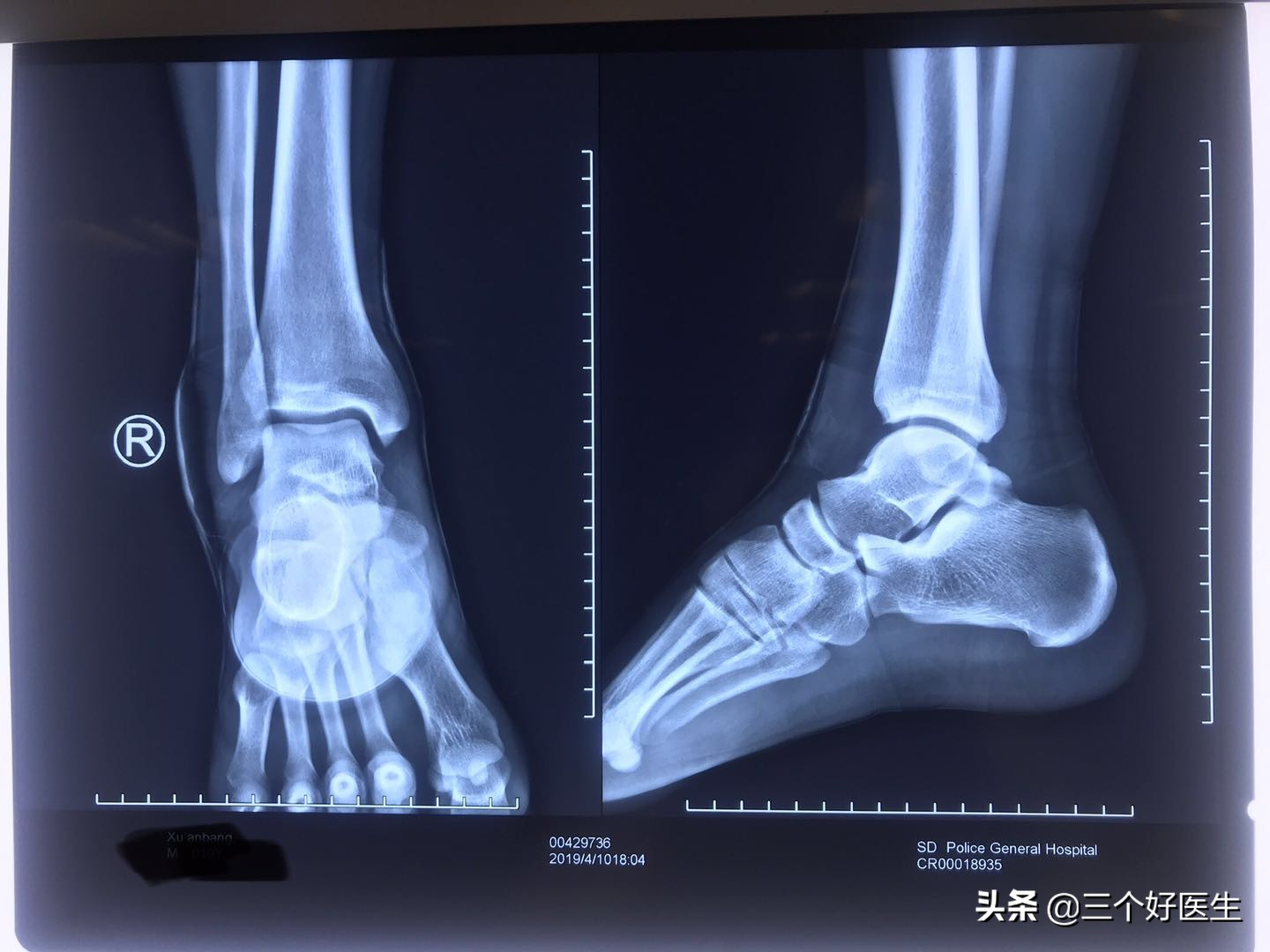 踝关节扭伤肿胀有瘀血需要弄破吗,踝关节扭伤软组织肿胀处理原则