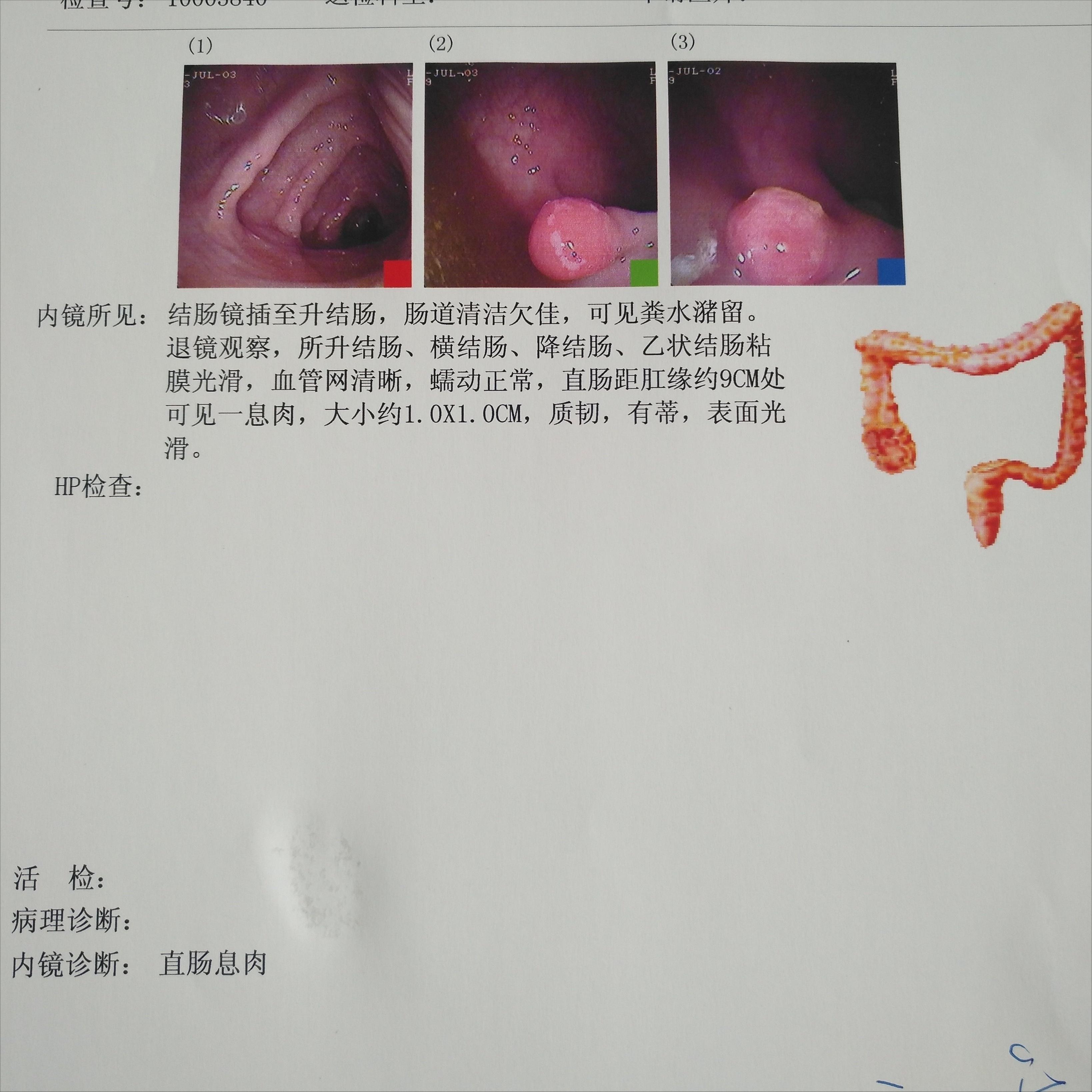 结节息肉囊肿增生哪个更容易癌变,结节囊肿增生息肉有什么区别