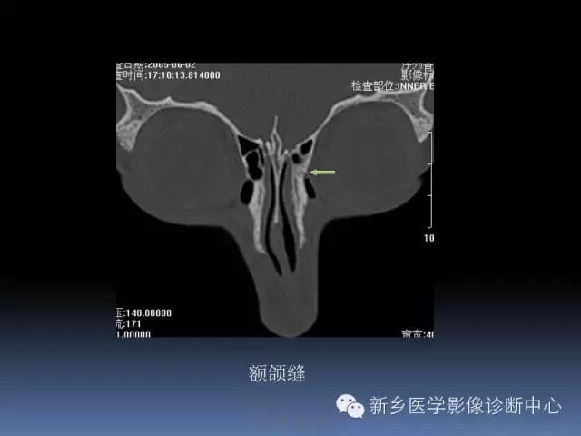 鼻骨骨折在ct片上的表现,鼻骨骨折ct怎么看