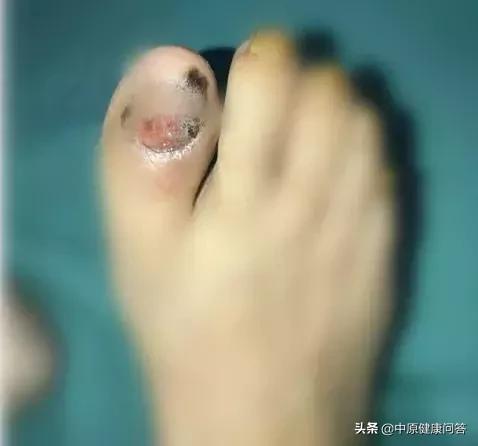 66岁女子为了治疗灰指甲把大脚拇指甲拔掉