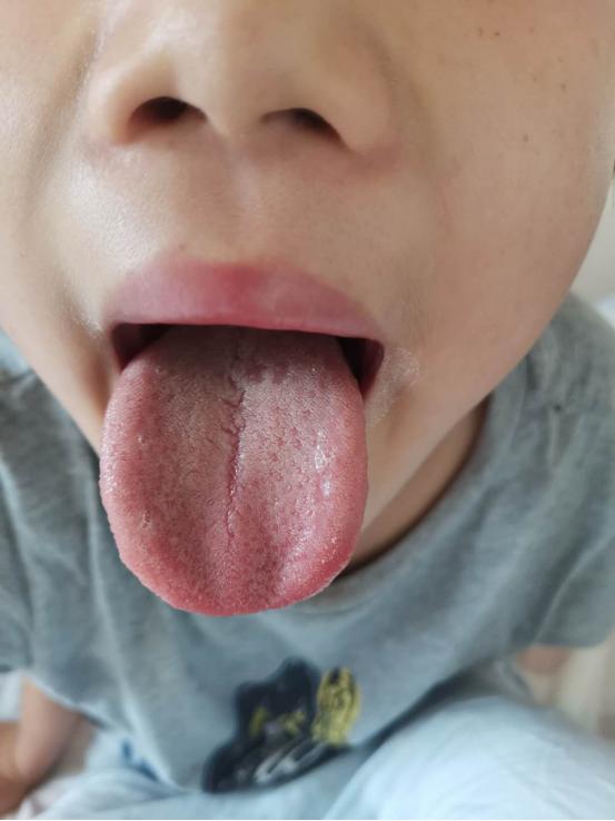 2岁宝宝脾胃虚拉肚子大便不成型,孩子腹泻一直没精神