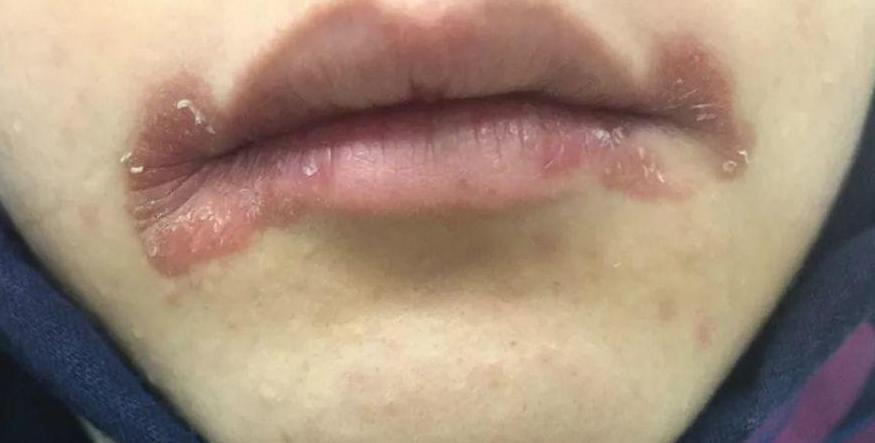 小孩上火烂嘴角最快治疗方法,因上火而烂嘴角吃什么药好呢