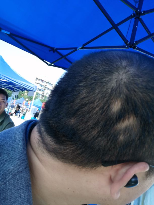 发现斑秃刚好又开始掉头发怎么办,突然发现斑秃怎么治疗