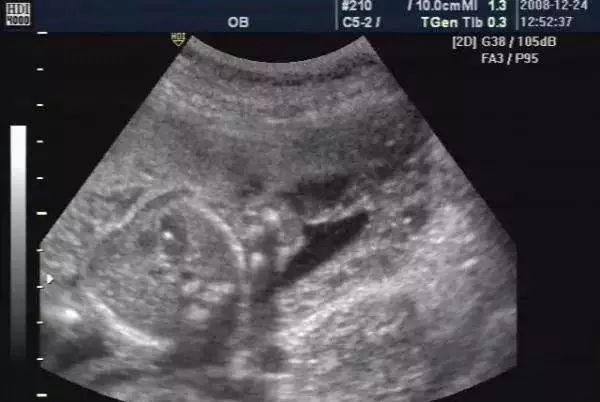 胎儿左右心室有强光斑是什么原因,胎儿左右心室有强光斑注意事项