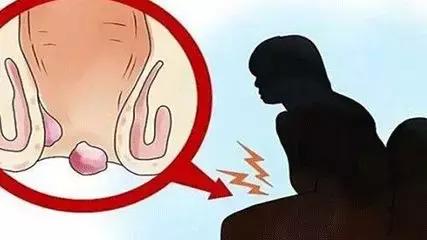 有痔青年如何远离痔疮,刚得痔疮怎样根治痔疮