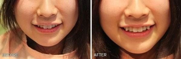 可爱的牙,可爱的老虎牙