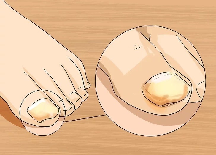 灰指甲真的治不好吗,灰指甲是不是治不好