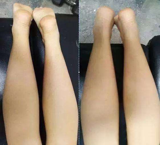 双腿大小不一样,小孩双腿大小不一样