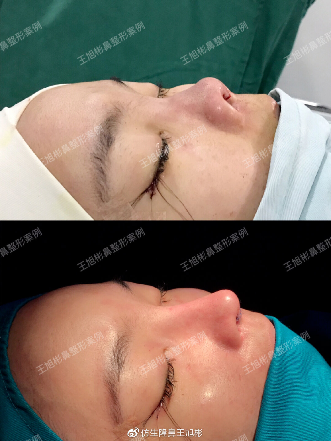 短鼻蒜头鼻整形,短鼻延长术切口